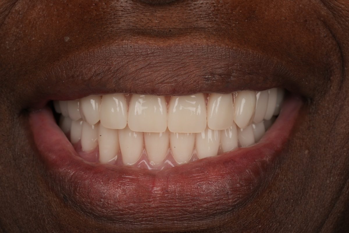 Pt. 1 After Smile